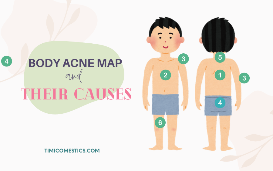 BODY ACNE MAP AND THEIR CAUSES BODY ACNE MAP AND THEIR CAUSES