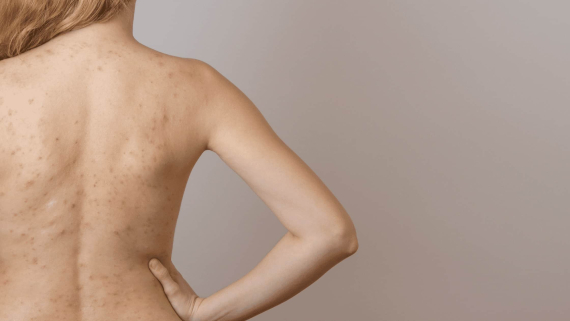 FORMATION MECHANISM OF BODY ACNE 🌿🔍