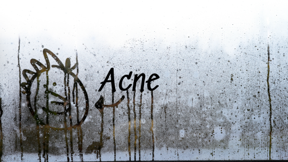 Humid Weather & High Moisture – Hidden Causes of Back & Body Acne!